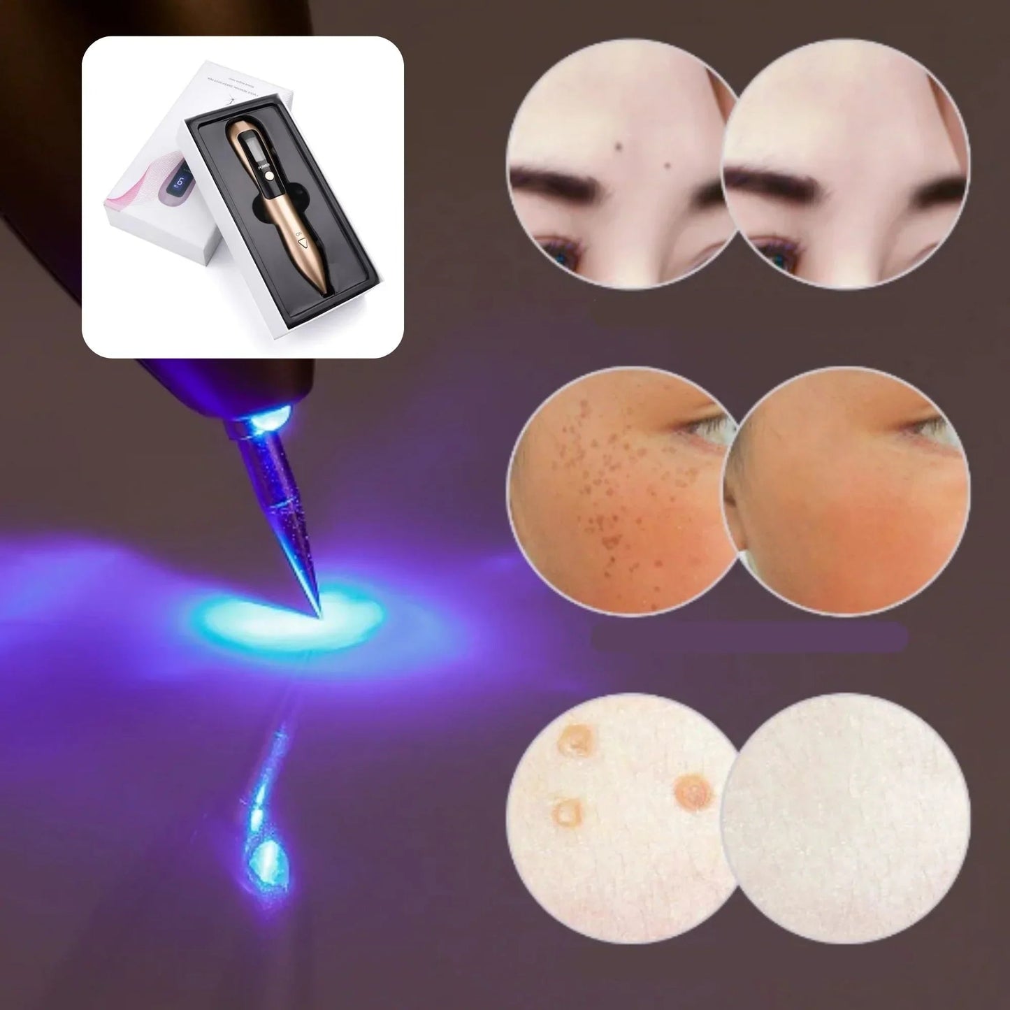 Elimina Verrugas Manchas Y Acné Cauterizador